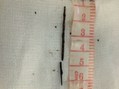 女孩胸腔取出钢针, 11大月女孩身体12根钢针获新生照片