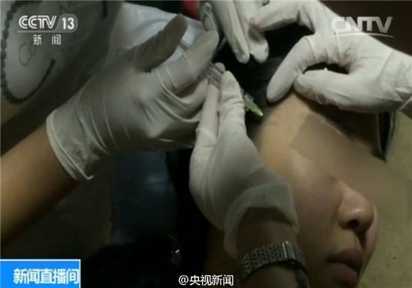 整容黑作坊真实内幕曝光图,玻尿酸微整形的副作用是什么(3)