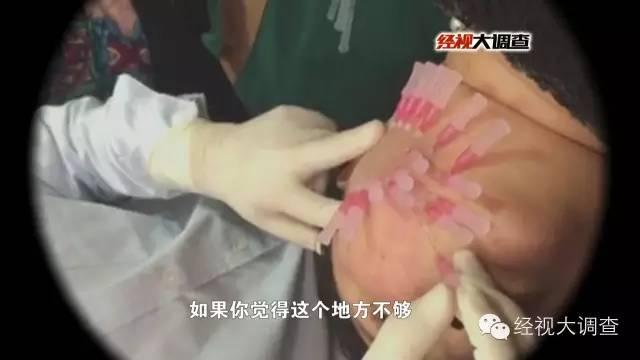 整容黑作坊真实内幕曝光图,玻尿酸微整形的副作用是什么(3)