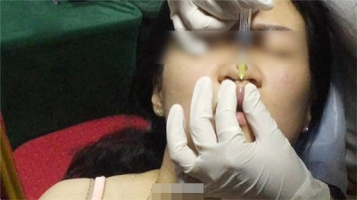 整容黑作坊真实内幕曝光图,玻尿酸微整形的副作用是什么(3)