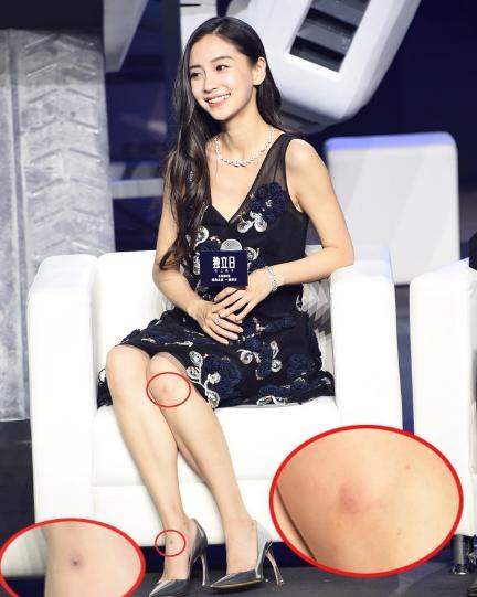Angelababy多处伤痕怎么回事?揭Baby伤痕原因是家暴吗(2)