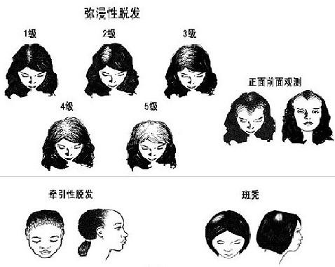 中国人脱发年龄提前20年,脱发的九大原因不止是因为年龄大!