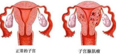 子宫肌瘤早期信号有哪些,子宫肌瘤忌口食物最怕的4种食物