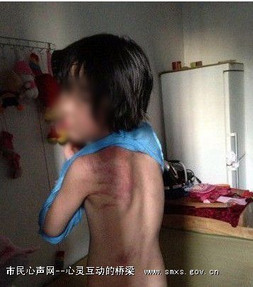 4岁女孩被父亲灼烫虐待图 盘点那些严重父母虐童事件图
