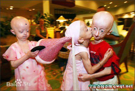 14岁少年患神秘早衰症图 早衰症的简介和早期症状有哪些