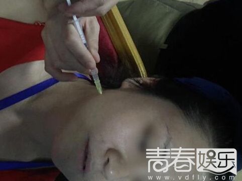 微整形行业内幕曝光图 注射玻尿酸微整形的危害有哪些图