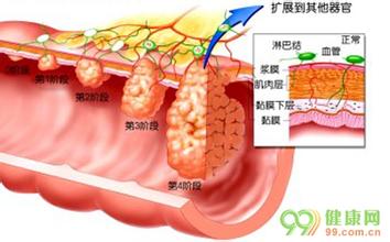 警惕结直肠癌疾病的早期症兆 中国结直肠癌发病率是多少