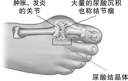 治疗痛风不能听信民间偏方 痛风症状及忌口食物表
