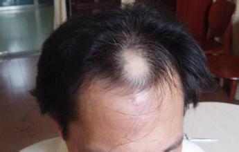 脱发是什么原因造成的?脱发怎么治疗最好的方法