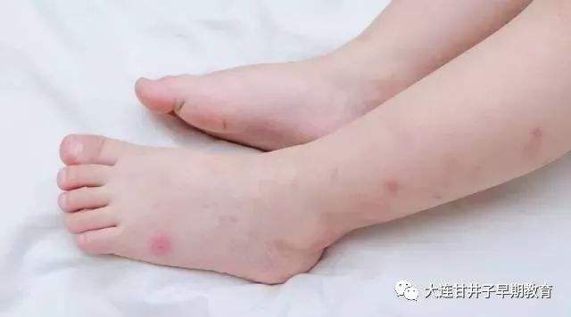 你知道蚊子为什么要吸人类的血吗?蚊子吸血后的寿命又是多久?