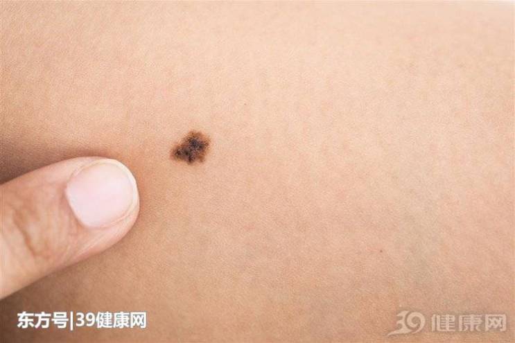 富贵痣的3个位置女人身上最好的痣 不会癌变痣皮肤癌一般位置