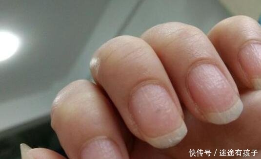 指甲看病图解肝不好指甲图片?指甲竖纹要担心是什么病
