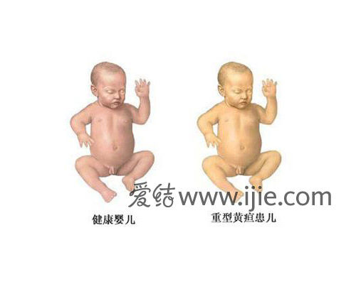 去黄疸最快方法消退只用四招 黄疸正常范围是多少超过多少入脑