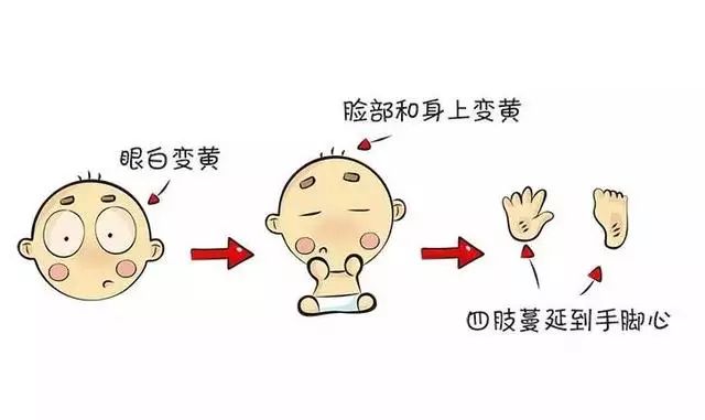 去黄疸最快方法消退只用四招 黄疸正常范围是多少超过多少入脑