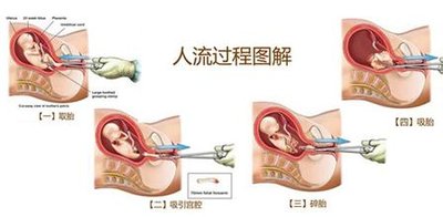 孕检时流产史可以隐瞒医生吗 做过人流的女人特征