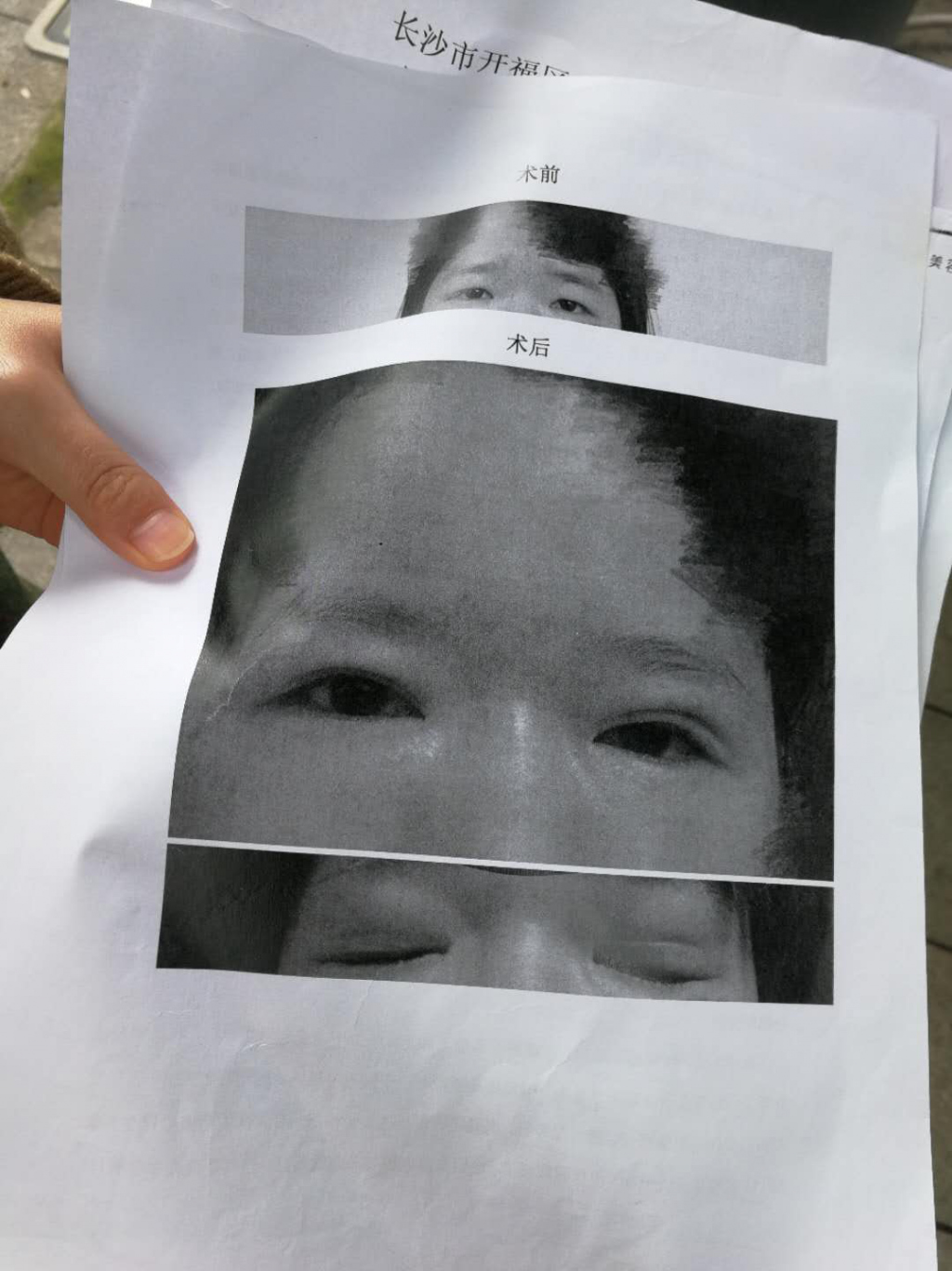 震惊!研究生整形双眼皮竟成大小眼 整容风险太大!